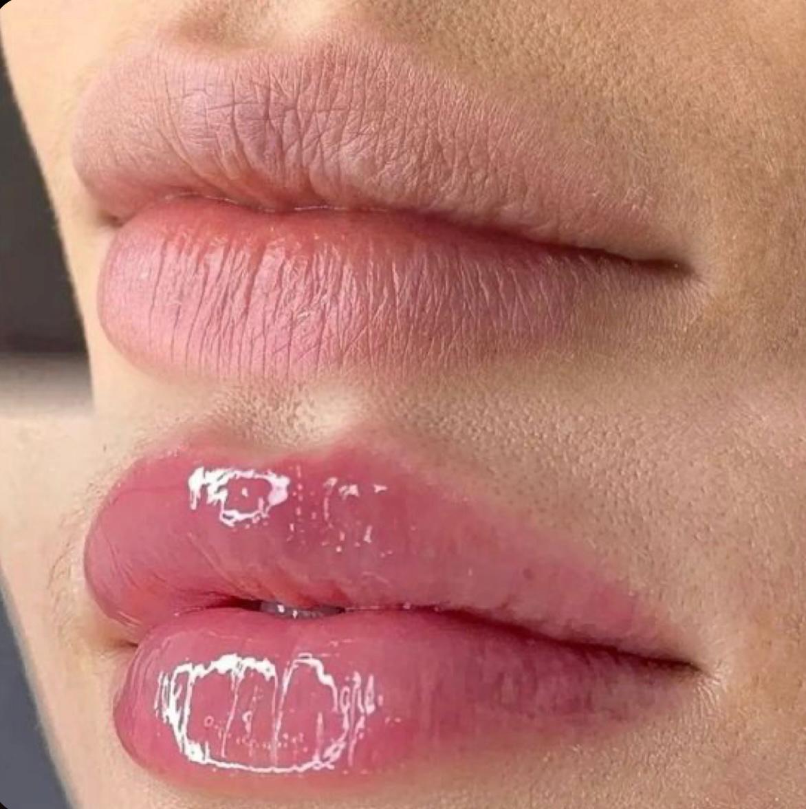 HIDRATACIÓN DE LABIOS CON ÁCIDO HIALURÓNICO